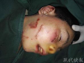 砍伤的伤口能否吃瓜,瓜类食物的食用指南